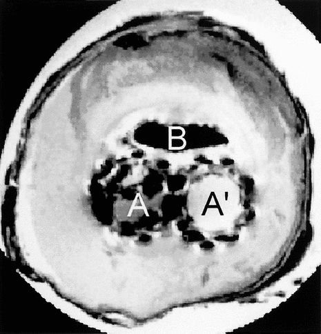 Figure 6 Proton density weighted image of the cross-section of the explanted device with two lumens, A, and A′, corresponding to both limbs of the device. The content of the aneurysmal sac has solidified whereas there is still an open canal likely to let fluids or blood flow.