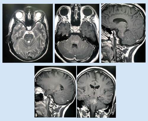 Figure 2. Marked regression of the brain lesions was observed in the MRI after 2 months of steroid therapy as compared with the initial MRI (May 2016).