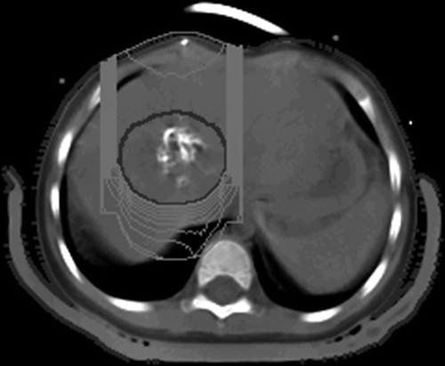 Figure 3. Treatment plan for proton beam therapy. The anterior beam was delivered to the main calcified tumor.