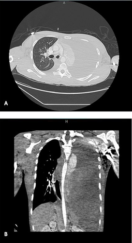 Figure 2 (A) Coronal and (B) Sagittal view of chest CT scan with and without intravenous contrast remarkable for a left diaphragmatic hernia with herniation of intra-abdominal contents. Additional findings of a possibly dilated stomach with an air-fluid level, large left pleural effusion, and a significant rightward shift of mediastinal structures.
