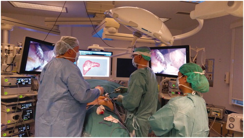 Figure 1. Use of segmentation models and CT scans as a navigation map for laparoscopic liver resection surgery.