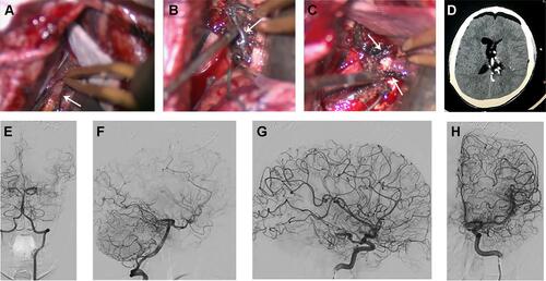 Figure 3 (A–C) Intra-operative views during surgery showing the dark embolized feeding arteries marked by Onyx® which were safely detached (arrows). Note the appearance of the nidus as a non-bleeding tuft of soft tissue. (D) Post-operative brain CT scan showing the bed of the resected AVM. Note the embolized arteries at the site of the devascularization and surgical detachment. (E–H) Post-operative cerebral angiography showing total resection of the AVM.