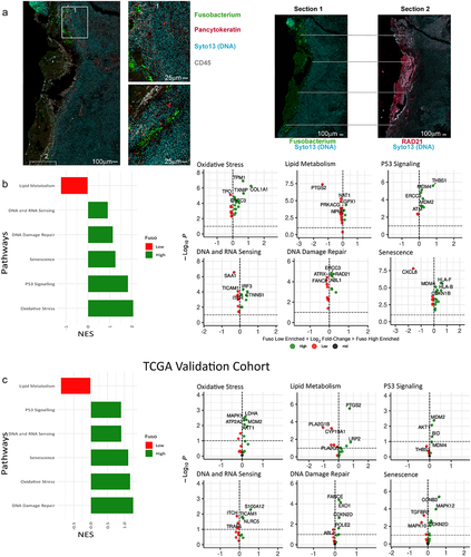 Figure 3. (a) Imaging of mucinous sample with GeoMx. Left: image of a tissue section showing fuso bacteria with insets (middle left) showing the localization of fusobacteria in higher magnification. On the right fusobacterial staining is shown together with RAD21 staining of a subsequent section of the same tissue highlighting examples of the close localization of fusobacterial and RAD21 staining with gray lines. (b) GSEA showing DNA damage and repair associated signaling pathways, that are differentially regulated in high versus low fusobacterial regions. A high normalized enrichment score (NES) indicates an overrepresentation of the genes in the fusobacterial high ROIs, and a low NES indicates an overrepresentation of the genes in the fusobacteria low samples. (c) TCGA validation cohort, which includes 594 patients with CRC (non-mucinous; n = 522, mucinous; n = 72). The 75th percentile of the fusobacteria load is used as a cutoff and the upper (75th) percentile indicates the “fuso high” and the lower percentiles mark the “fuso low”.