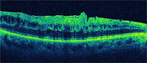 Figure 17 The epiretinal membrane is delineated as a highly reflective band and is globally attached to the retina.