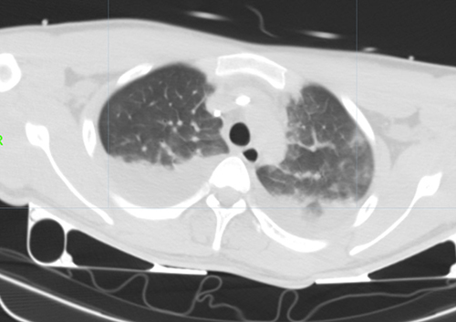 Figure 1 Chest CT showed compression atelectasis and consolidation in bilateral lower lung.