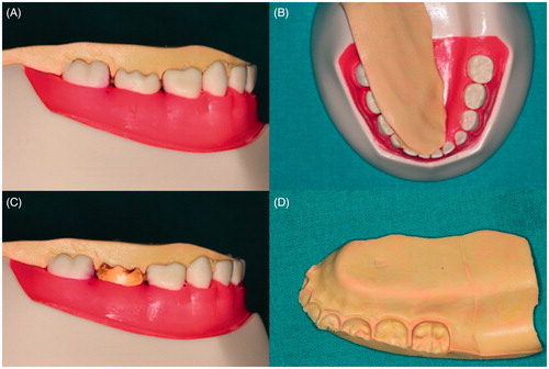 Figure 4. (A and B) Occlusal stamp with master tooth. (C) Occlusal stamp with duplicated tooth. (D) Occlusal stamp.