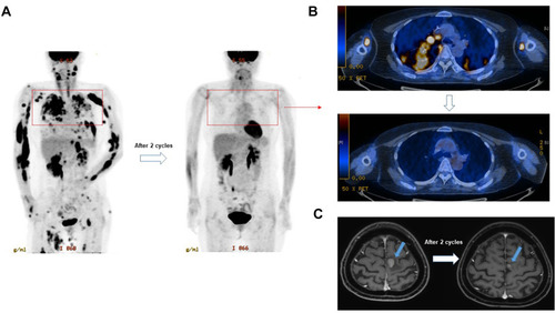 Figure 2 A representative case responding to lenalidomide and rituximab treatment after systemic and CNS relapse. (A and B) The PET/CT scan showed the disappearance of multiple FDG avid lesions after two cycles of lenalidomide and rituximab. (C) The brain MRI also showed the decrease of mass lesion (blue arrows) after two cycles of treatment.