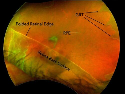 Figure 7 Fundus image of a giant retinal tear (GRT) extending from 9 to 5 o’clock in the left eye.  GRT is most commonly seen in childhood retinal detachments of Stickler syndrome patients.