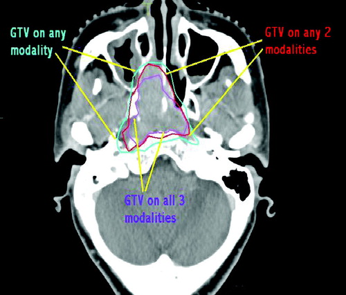 Figure 2.  Derived GTVs viewed on CT image.