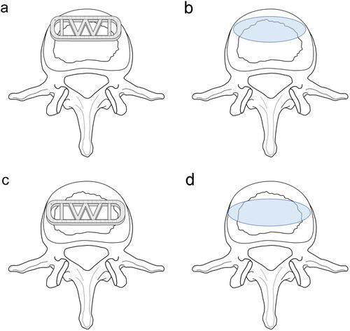 Figure 4. (a)–(b) The anterior-inferior edge of the cage falls on the anterior part of the epiphyseal ring and the cage footprint area on the endplate. (c)–(d): the anterior-inferior edge of the cage falls behind the anterior part of the epiphyseal ring and the cage footprint area on the endplate.