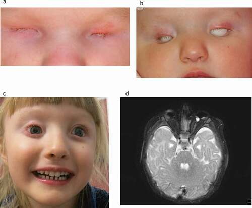 Figure 1. (a–d) Girl born with total blindness (amaurosis) due to right sided anophthalmia and left sided microphthalmia. There was no bulb on the right side and a very small, rudimentary bulb 5 mm on the left side. (a) New-born child, one month of age. (b) Treatment with expanding conformers, here 10 months of age. (c) Six years of age with bilateral prostheses. (d) MRI of the brain and orbits showing anophthalmia right eye and microphthalmia left eye (Published with permission from parents) .