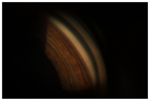 Figure 3 One week following cryotherapy, the anterior chamber is formed.