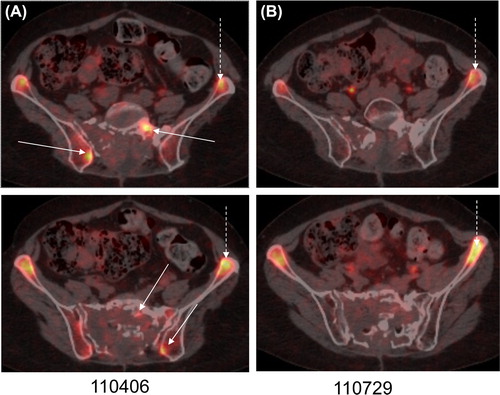 Figure 2. (A and B): (A and B): 18F-FLT-PET/CT in April (A) and July (B) 2011. (A) FLT-uptake was high in the tumor, indicating enhanced proliferative activity (white continous arrows), before chemotherapy. The non-tumour affected bone marrow also showed high uptake (white broken arrows), but this is a normal finding. (B) In May erlotinib-bevacizumab was started, and in July no remaining FLT uptake could be seen in the tumor (white continous arrows). As expected, FLT-uptake in the non tumour affected bone marrow was still unchanged (white broken arrows).