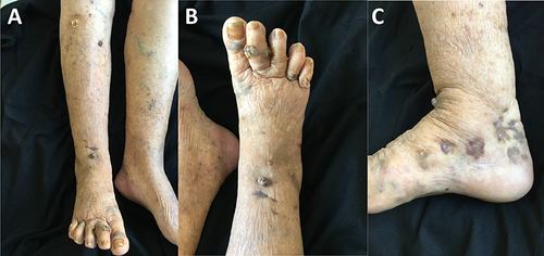Figure 1 (A–C) Scattered dark purple peanut to thumb-sized nodules, ulcers, purulent discharge, bruising, and varicose veins in both lower extremities.
