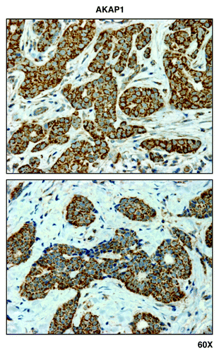 Figure 1. AKAP1, a mitochondrial marker, is predominantly confined to epithelial cancer cells, and largely absent from adjacent stromal cells, in human breast cancer tissues. Paraffin-embedded sections of human breast cancer tumor tissue were immunostained with antibodies directed against AKAP1. Slides were then counter-stained with hematoxylin. Note that AKAP1 is highly expressed in the epithelial compartment (brown color). Two representative images are shown. Original magnification is 60x, as indicated.