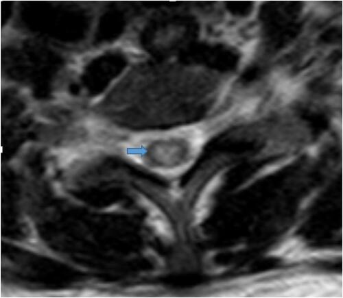 Figure 3 Axial T2-weighted image at the level of T3 revealed central cord hyperintensity.