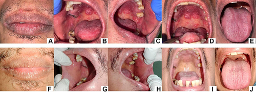 Figure 2 White plaque with erythematous area on the palate, buccal mucosa right and left, and tongue (A–E). Fissured on the corners of the lip. Second visit (three weeks), the lesions disappeared (F–J).