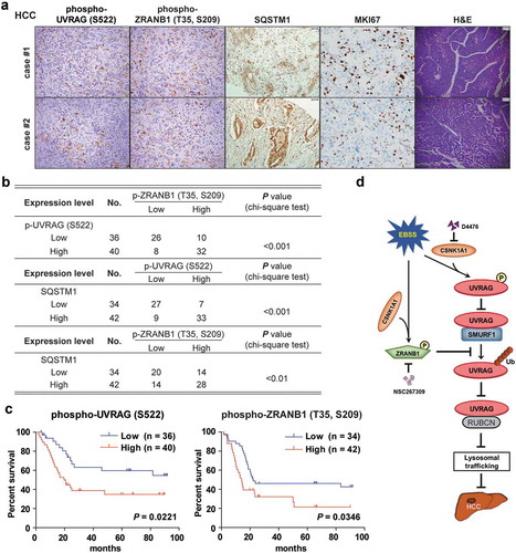 Figure 10. CSNK1A1-dependent UVRAG (S522) and ZRANB1 (T35, S209) phosphorylation are associated with poor prognosis in HCC patients. (a) Representative H&E (scale bar: 78.57 μm) and immunohistochemical staining (scale bar: 39.29 μm) with antibody against UVRAG (S522) or ZRANB1 (T35, S209) phosphorylation or SQSTM1, MKI67 of 76 human HCC tissues. Representative images are shown. (b) Chi-square analysis of data described in (a) was performed depending on the staining scores (low staining, 0–4; high staining, 5–8). (c) Kaplan-Meier analysis on the overall survival rates of 76 HCC patients in the groups of low or high expression of UVRAG (S522) and ZRANB1 (T35, S209) phosphorylation levels. (d) Schematic model of UVRAG ubiquitination and phosphorylation regulation by SMURF1-ZRANB1-CSNK1A1 system on autophagy maturation and HCC growth. Nutrition starvation or other autophagy-inducing signals activate CSNK1A1, which phosphorylates UVRAG at S522 and ZRANB1 at T35, S209 respectively. This phosphorylation disrupts SMURF1-mediated UVRAG K29-and K33-linked ubiquitination at K517 and K559 residues, which inhibits autophagosome maturation and EGFR degradation, thereby promoting HCC growth.