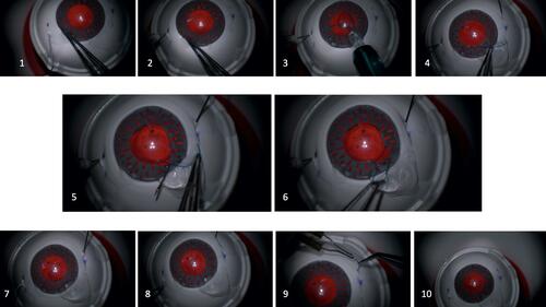 Figure 1 Step by step procedure in chronological order of externalized trailing haptic Yamane method on an artificial eye (Artificial eye is courtesy of Dr. Stuart Stoll and SimulEYE).