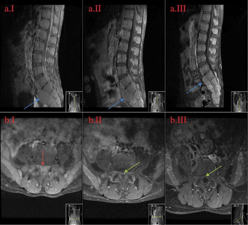 Figure 2. MRI of the lumbar spine in sagittal and axial views at the levels ofL5-S1.A = sagittal view; B = axial view; I = initial presentation; II = day 14th after diagnosis; III = week 11th after diagnosis. The images show regression of the central spinal canal stenosis: from near-complete-obliteration on the initial image (B.II.1 red arrow) to the subsequent re-emergence of the spinal canal (B.II.2 and B.II.3 green arrow) with medical treatment. Also noted is the decrease in size of the bony masses and is the most prominent in the sacral region (II.A images blue arrow).