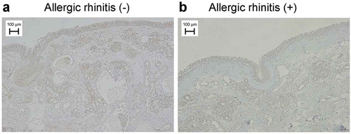 Figure 5. Histidine decarboxylase (HDC) protein expression, observed by immunostaining in the mucous membrane of the inferior nasal concha of patients with/without allergic rhinitis. The slides were viewed under a microscope (Olympus BX51; 200× magnification). Scale bar indicates 100 μm for two micrograph images.