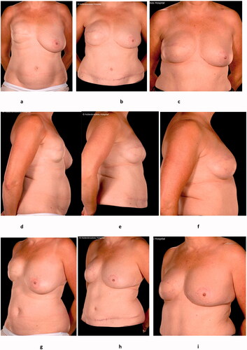 Figure 1. Clinical photographs of the AP, right lateral and left oblique views of the patient before salvage surgery (a, d, g), after the DIEP flap (b, e, h) and after fat grafting (c, f, i) to the volume deficit and the contour deficiency especially in the take-off superiorly.
