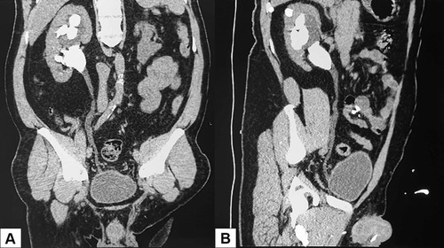 Figure 2 Coronal (A) and sagittal (B) plane view of the right ureter reconstruction showed no ureteric stone, kinking, or stenosis.