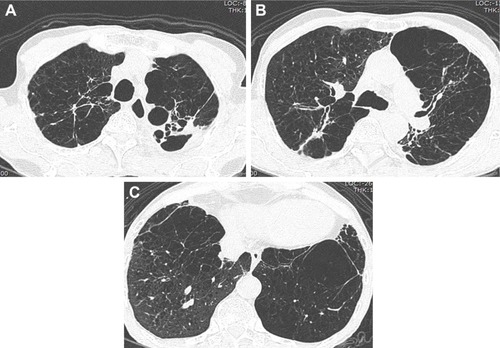 Figure 4 Axial CT images with a lung-window setting showing severe centrilobular emphysema and bronchiectasis in both lungs (A–C).Abbreviation: CT, computed tomography.