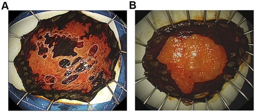 Figure 2 Images of endoscopic submucosal resection specimens stained by Lugol dye solution. (A) A lesion with more than five stained spots (marked by white circles), which were independently scattered in the iodine-unstained area, without connection to the surrounding iodine-stained area, was defined as positive for multiple stained spots in an iodine-free area. (B) A lesion with less than five scattered, deep-stained spots in the iodine-unstained area; negative for multiple stains in the iodine-free area.