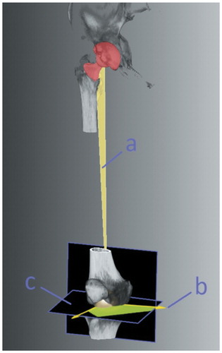 Figure 2. 3D-CT assessment of femoral stem torsion. The mechanical axis of the femur, defined by the center of the most caudal points of the femoral condyles, the center of the femoral head, and the vector, representing the neck of the prosthesis, formed a plane (a) from which a second vector (b) was calculated. With the condylar axis, it was projected onto a plane (c) that was orthogonal to the mechanical axis. The angle between these vectors minus 90° was the femoral stem torsion.