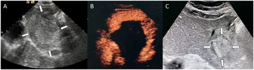 Figure 3. Ultrasonographic images of a 38-year-old female patient with large hepatic hemangioma who received single-session percutaneous sclerotherapy with 15 mg bleomycin. (A) A homogeneous hyperechoic lesion with an initial size of 6.0 cm × 4.3 cm × 3.5 cm was detected in the right lobe of the liver. (B) Size of the sclerotherapy area was 3.6 cm × 2.6 cm × 1.7 cm at 12 months after treatment.