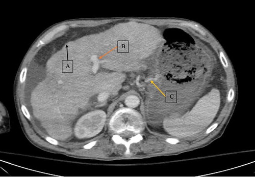 Figure 2. CT scan showing hepatic cirrhosis (a), portal hypertension (b), and gastric varices (c)