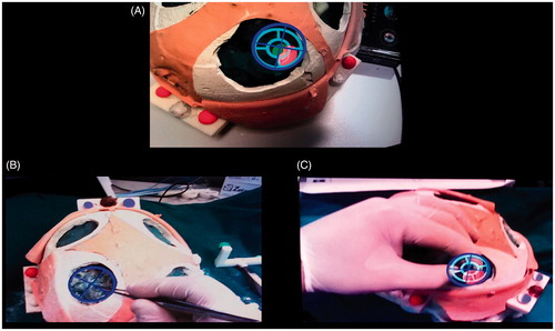 Figure 9. The AR-aided surgical tasks. A: The surgeon first aligns the tip of the dissecting instrument to the center of the dark blue viewfinder he/she sees in the AR scene; B: the surgeon coaxially aligns the back of the surgical forceps to the two viewfinders (dark blue and light blue). The two viewfinders define the optimal trajectory of dissection.