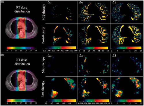 Figure 1. Visualizing axial (a) CT and (b) 18F-FDG-PET images. Left: RT dose distribution registered with planning CT for one patient with dose ranges from 0 to 30 Gy (left most color bars). Right: Δμ, Δσ and ΔS maps were displayed during (top) and six weeks post (bottom) treatment. Units are HU for CT, while PET values are unitless. ΔS maps both in mid- and post-therapy visualized new regions of interest that were not visible in the Δμ maps.