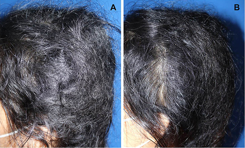Figure 3 The improvement of the matted hair: (A) before and (B) after four weeks of treatment, smaller hair masses and normal hair around their borders were visible.