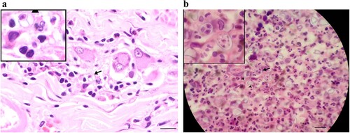Figure 2. Photomicrograph of section from the (a) colon of Case 1 and (b) skin of Case 4 showing endosporulating algal organism (arrows) with internal septation in both locations and empty theca (arrow heads) in the section of skin (H&E; bar = 30 μm). These are magnified in the insets.