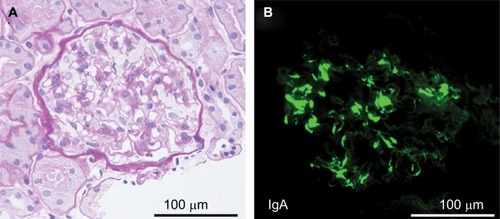 Figure 2 The renal biopsy findings.