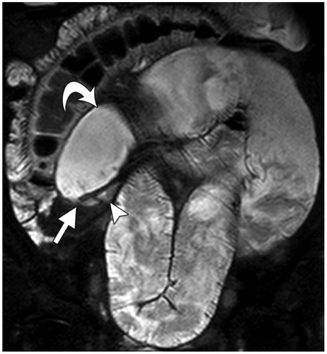Figure 10: Reproduced with permission from: Amzallag-Bellenger E, Oudjit A, Ruiz A, et al. Effectiveness of MR enterography for the assessment of small-bowel diseases beyond Crohn Disease. RadioGraphics 2012;32:1423–1444. Adhesive ileal obstruction in a 30-year-old woman with a history of appendectomy and recurrent low-grade bowel obstruction. MR enterography was performed after the administration of 1 litre of an oral contrast agent. Coronal FISP image from MR enterography demonstrates ileal loop dilatation (curved arrow), a transition point (straight arrow), and normal distal caliber (arrowhead). No mass, bowel wall thickening, stricture, or other specific cause of obstruction was identified. These findings were suggestive of an obstruction due to bowel adhesion, which was later confirmed at laparotomy