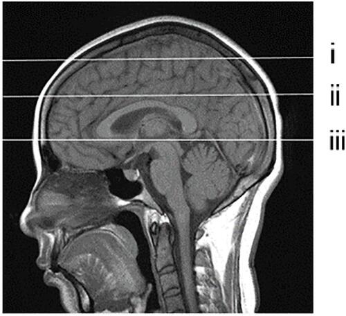Figure 2 Selection of PVS observation layer shown in the sagittal view. (i) frontoparietal subcortical white matter layer; (ii) centrum semiovale layer; (iii) basal ganglia layer.