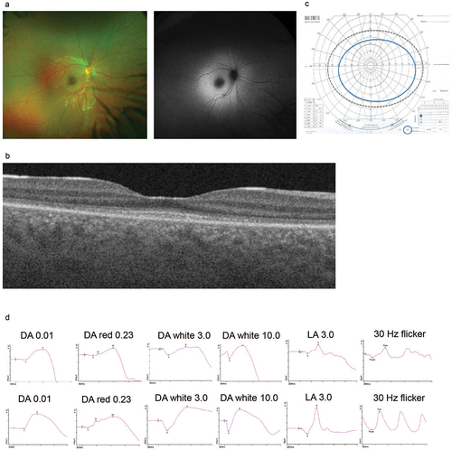 Figure 2a. Ophthalmological phenotype (Patient III-1). (a): fundus images and (b): OCT shows increased autofluorescence signal in the posterior pole and disruptions in the outer nuclear layer corresponding to photoreceptors; (c): Goldman visual fields (tested to II4E isopter) present well- preserved fields; (d): upper panel—full filed ERG shows reduced function of cone photoreceptors with preserved function of rod photoreceptors, lower panel—age-adjusted normative data.