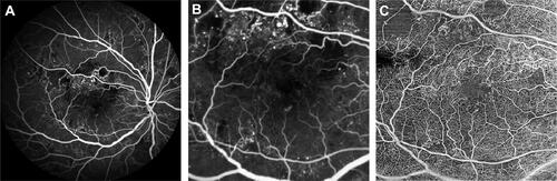 Figure 1 Original images from a patient with severe non-proliferative diabetic retinopathy with macular edema. (A) Fluorescein angiography (FA) image. (B) Cropped FA image scaled to the 6 x 6 mm macular region shown in the corresponding swept-source optical coherence tomography angiography (SS-OCTA) image. (C) 6 x 6 mm macular SS-OCTA en face image from the total retinal layer slab. In the SS-OCTA image, areas of capillary dropout are clearly evident, and the retinal microvasculature can be better appreciated. In the FA image, larger superficial vessels are emphasized and microaneurysms along with patchy areas of macular ischemia can be seen.