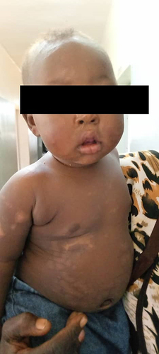 Figure 5 Infant’s Progress at 6 Months: Image displaying the resilient survivor of a burial immediately after birth. Captured during the routine 6-month visit, showcasing normal growth, good nutritional status, attainment of age-appropriate developmental milestones, and visible skin lesion scars.