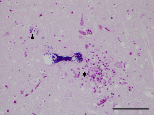 Figure 1 Brainstem: a parasitophorous vacuole with distinct Gram-positive 1.5 × 2.5 µm spores. A few single Gram-positive spores can be seen escaping from the vacuole into the adjacent neuropil (arrowhead). There are increased numbers of microglial cells and astrocytes (gliosis) and likely a few lymphocytes, all of which stain pink, and a few viable neurons (⋆). (Gram’s stain, 400× magnification, bar 50 µm).
