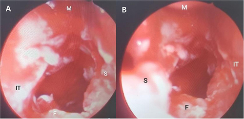 Figure 3 Intraoperative nasal endoscopic images show patency of the right (A) and left (B) choanae.
