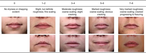 Figure 1 Photonumeric lip dryness grading scale.