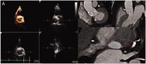 Figure 1. Illustration of left ventricular outflow tract in three-dimensional echocardiography and with computer tomography. (a) Example of measurement of LVOT in 3D TTE from the parasternal long-axis view. The 3D images were analysed through three different orthogonal cut planes: The white is a short axis plane of the LVOT and the green and yellow are sagittal views of the ascending aorta. The yellow and green lines were moved to the hinges of the aortic valve to measure the LVOT. (b) Example of CT images and software used to obtain the optimal view of the aortic annulus using three lines representing three orthogonal cut planes.
