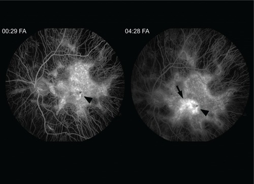 Figure 3 Fluorescein angiogram (FA) transiting the left eye reveals diffuse atrophy of the choriocapillaris sparing the central macula.