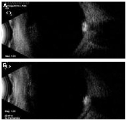 Figure 3 Ultrasound of (A) right eye and (B) left eye.