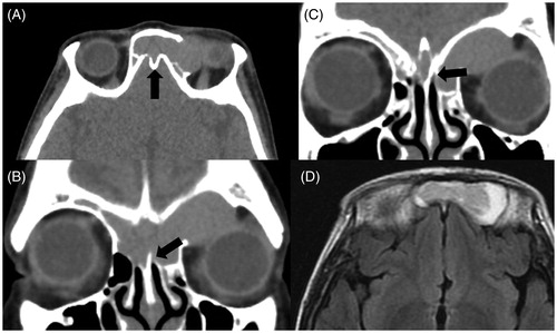 Figure 2. CT demonstrated that the lesion existed in both of the frontal sinuses, invading the left orbit by destroying the orbital roof (A), and there was a ‘niche’ at the center of the frontal skull base instead of the frontal septum (A: black arrow). The frontal sinus septum was mostly destroyed but partially remained in a ‘Y’ shape, which implied ballooning and bursting of the mucocele of ISSC into both sides of the frontal sinus (B, C: black arrow). MRI showed a moderate-intensity mass in the middle of the frontal lesion surrounded by a high-intensity area on T1-weighted imaging (D).