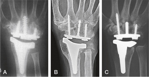 Figure 16. The development of the Universal arthroplasty system. A) Menon’s first edition. (From J Menon, Journal of Arthroplasty 1998, reprint permission from Rightslink). B) The second edition (Universal) with the central peg with indentations. C) The contemporary Universal 2. B) and C) Courtesy of Dr van Winterswijk.